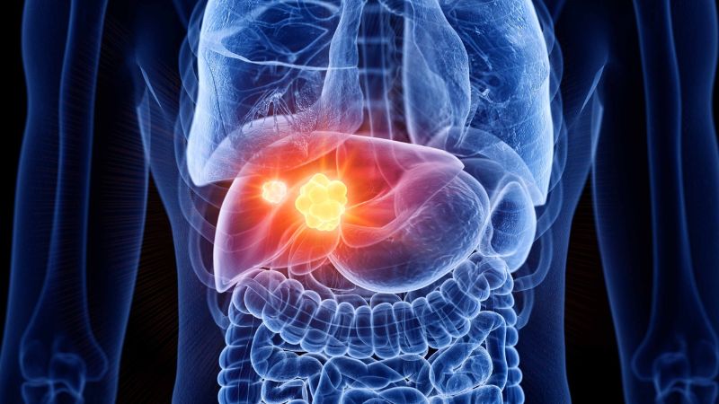 The Consequences of Liver Cirrhosis on Health