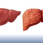 The Consequences of Liver Cirrhosis and Effective Treatment Approaches