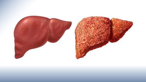 The Consequences of Liver Cirrhosis and Effective Treatment Approaches