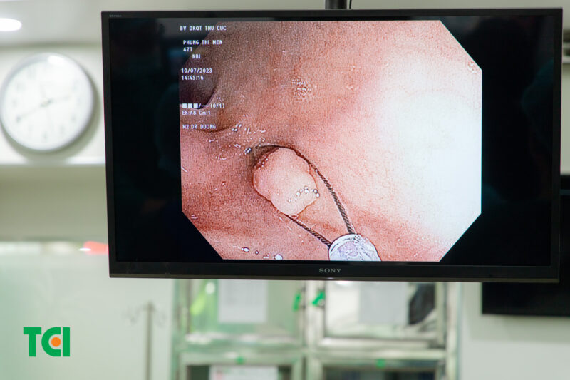 Advantages of Sedated Gastroscopy at TCI