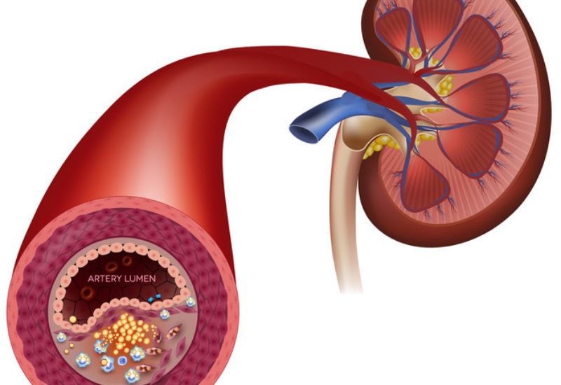 Serious Complications of Hypertension That Require Attention