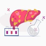 Non-Alcoholic Fatty Liver Disease: Causes, Risks, Management