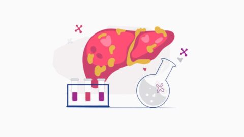 Non-Alcoholic Fatty Liver Disease: Causes, Risks, Management