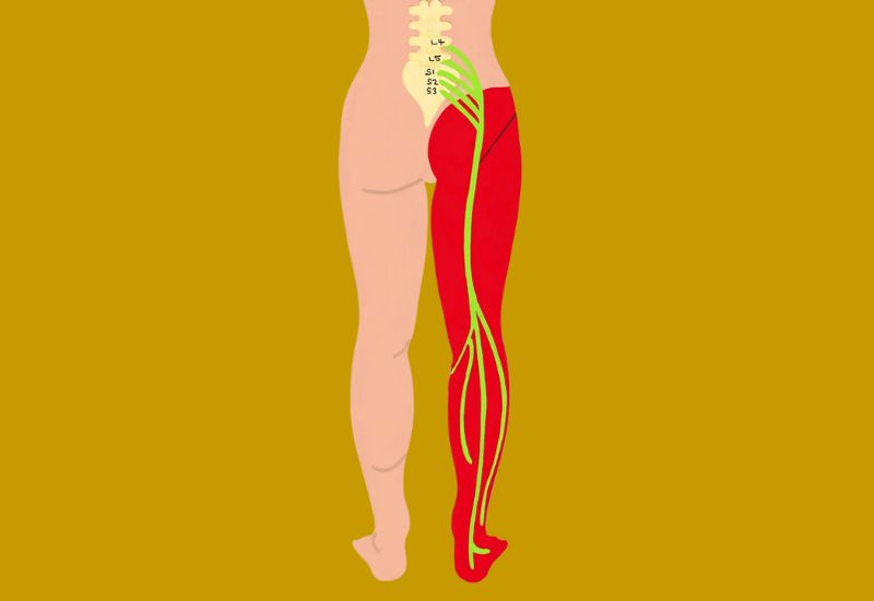 What Is Sciatica?