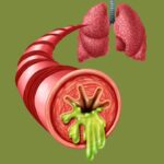 Acute Bronchitis Symptoms and Effective Treatment Options