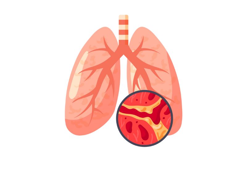 What Is Acute Bronchitis?