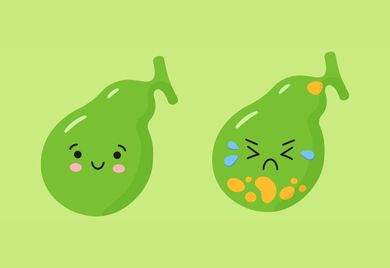 Common Causes of Gallstones