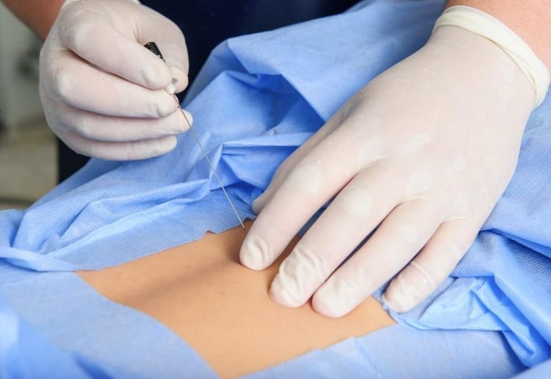 Benefits of Epidural Analgesia for Post-Cesarean Pain Relief