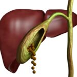 Gallbladder Stones: Essential Information Everyone Should Know