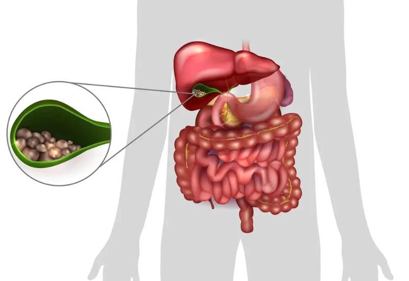 What Are Gallbladder Stones?
