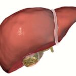 Causes of Gallstones You Should Know for Better Prevention
