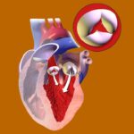 Heart Valve Regurgitation: Common Types, Clinical Features, and Treatment