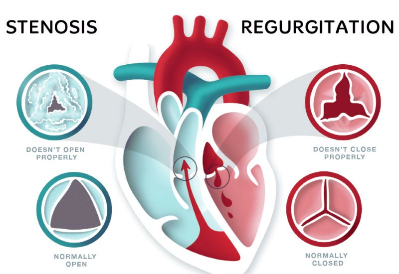 Overview of Heart Valve Regurgitation