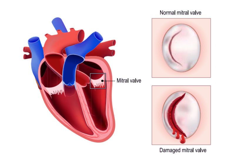 Major Forms of Heart Valve Regurgitation